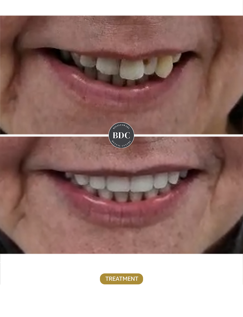 All-on-4-upper-replacement-before-after