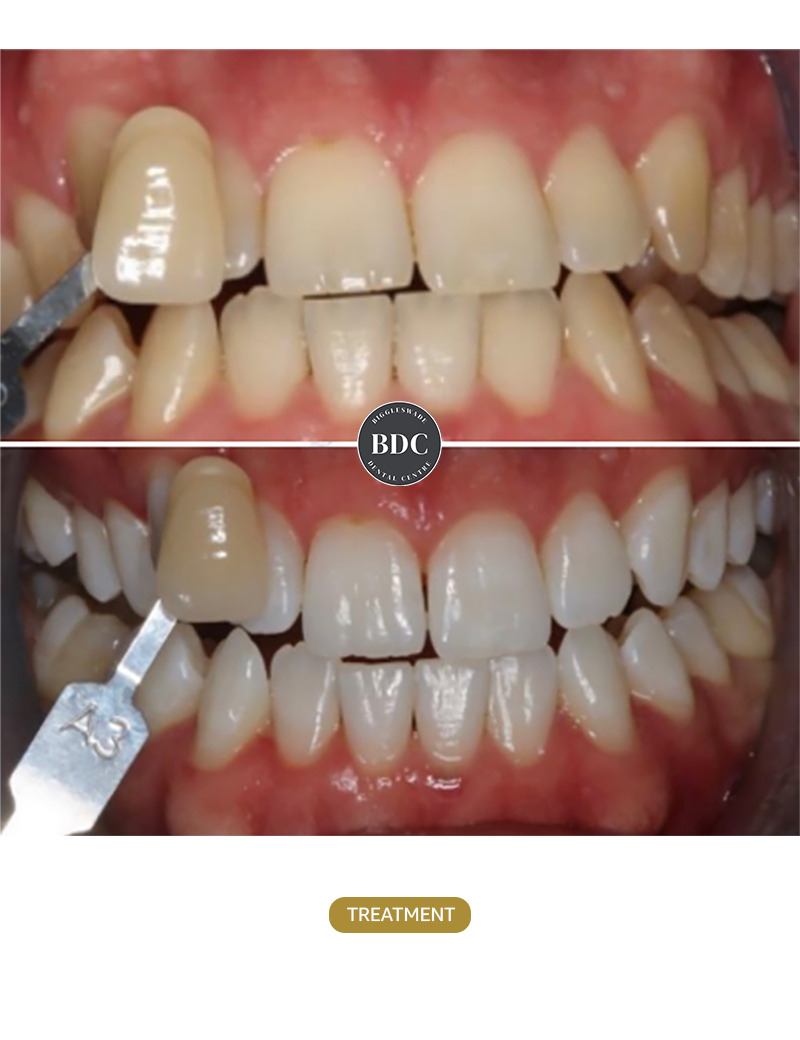 Boutique-Whitening-before-after