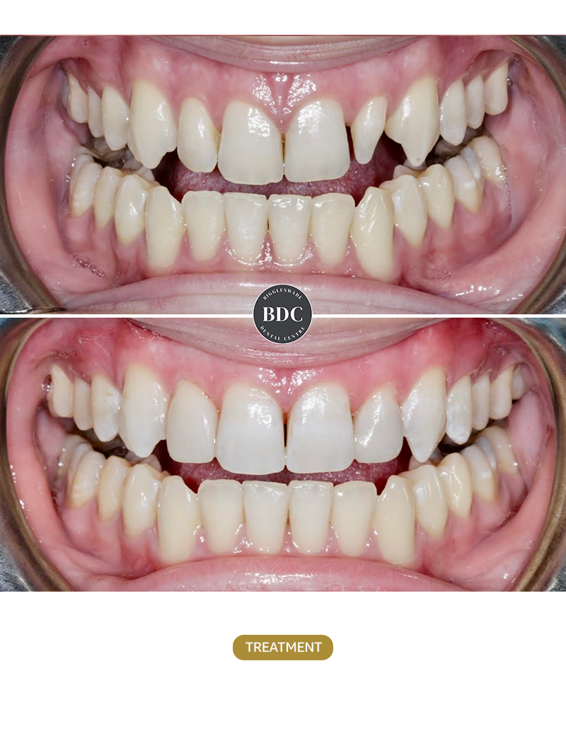 Composite-Bonding-1-before-after