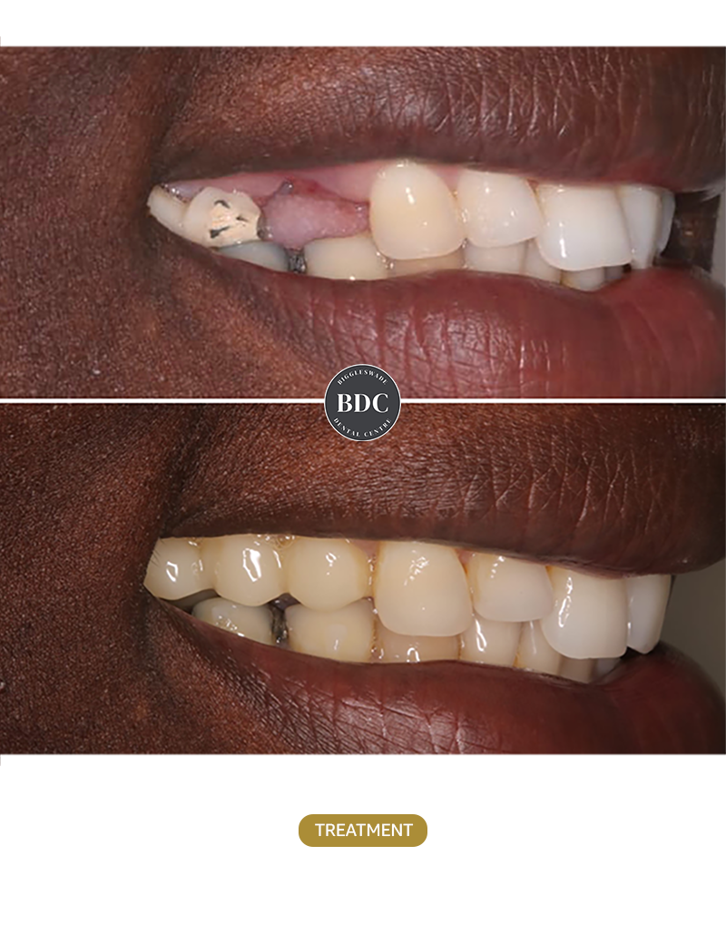 Dental-Implants-1-Before-afetr