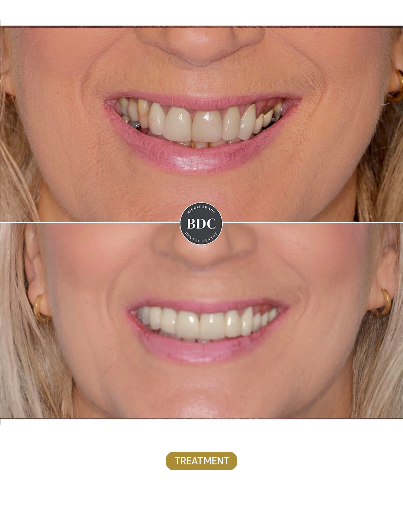 Implants-and-Crowns-befor-afetr