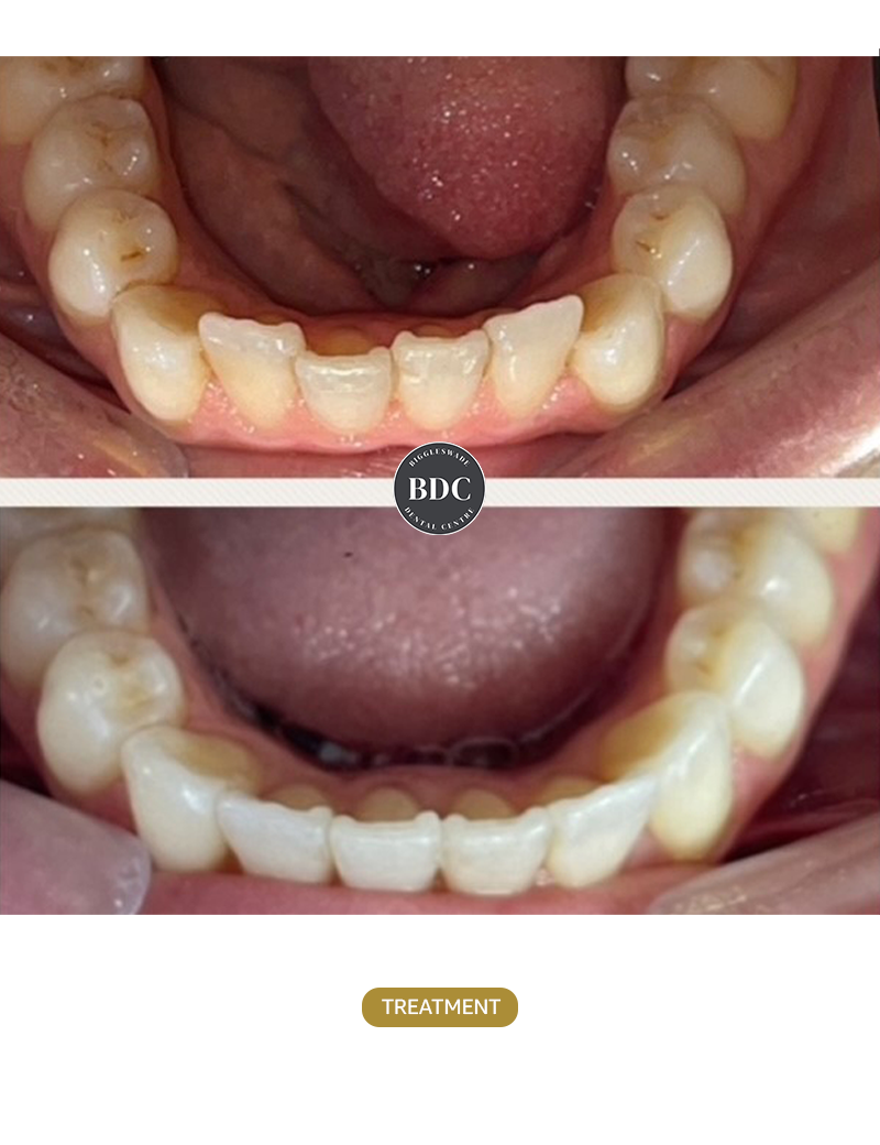 Invisalign-1-before-afetr