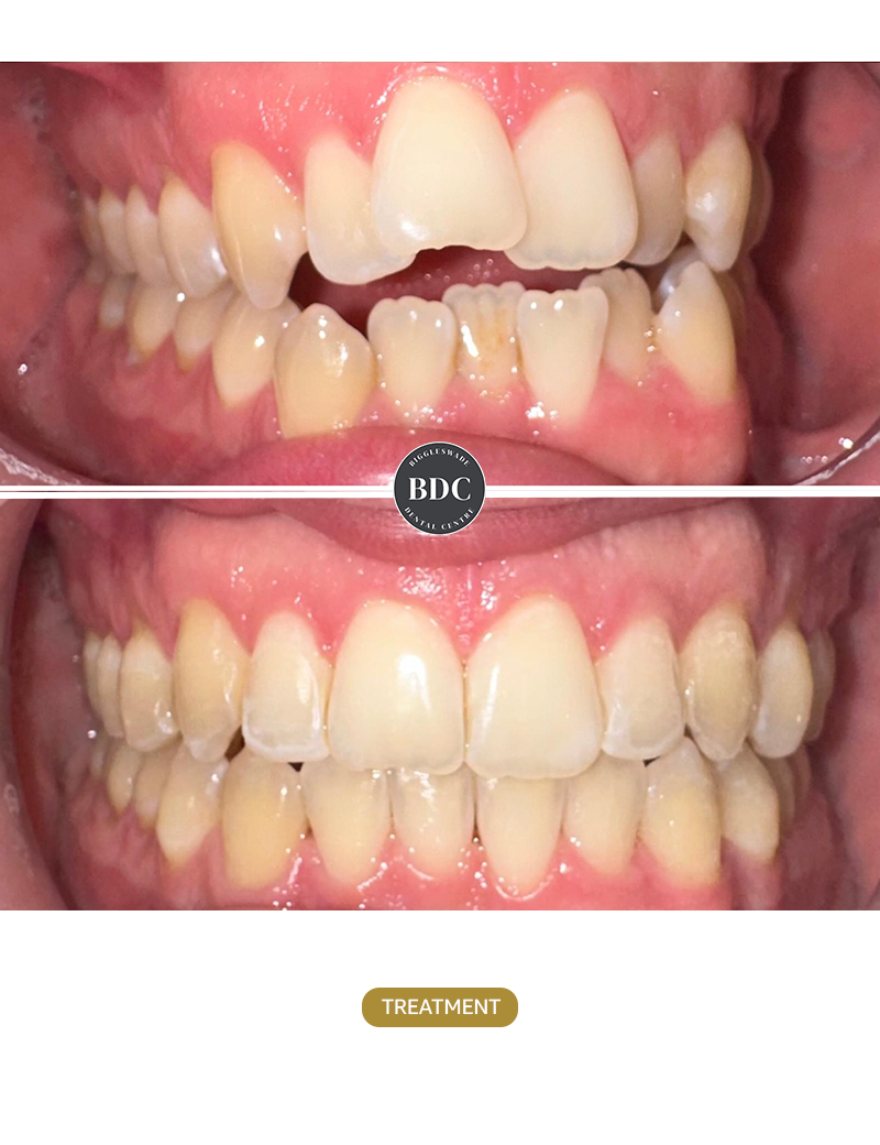 Orthodontic-(Fixed-braces)1--Before-and-After