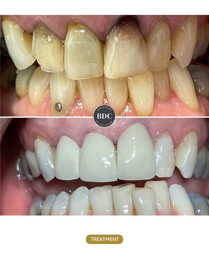 Whitening-and-Crowns-before-afetr
